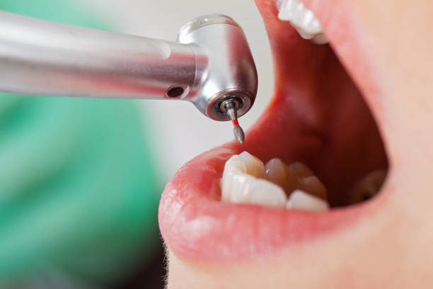 Best Emergency Treatment for Dental Infections or Abscesses in Springville, IA